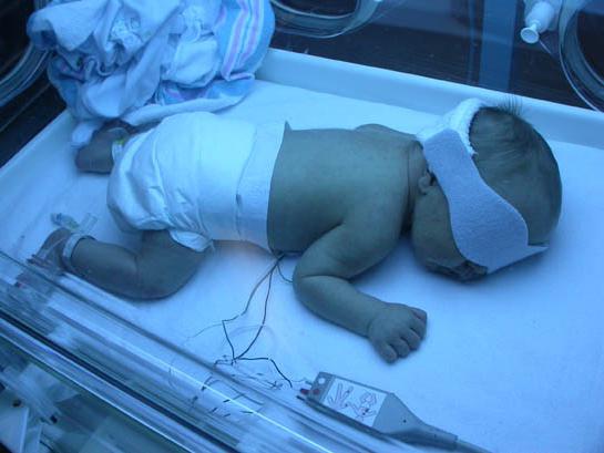 Недоношенный ребенок под кварцевой лампой
