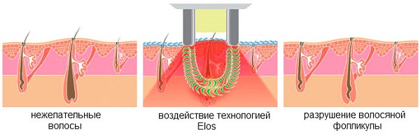 Технология элос-эпиляции